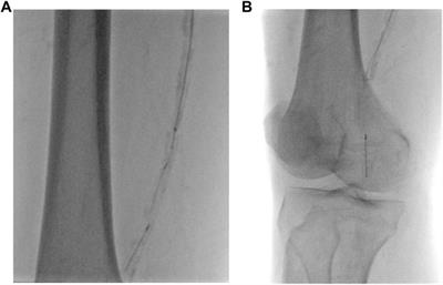 Fracture and dislodgment of a guidewire retrieved by a Solitaire AB neurovascular remodeling device